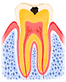 虫歯2